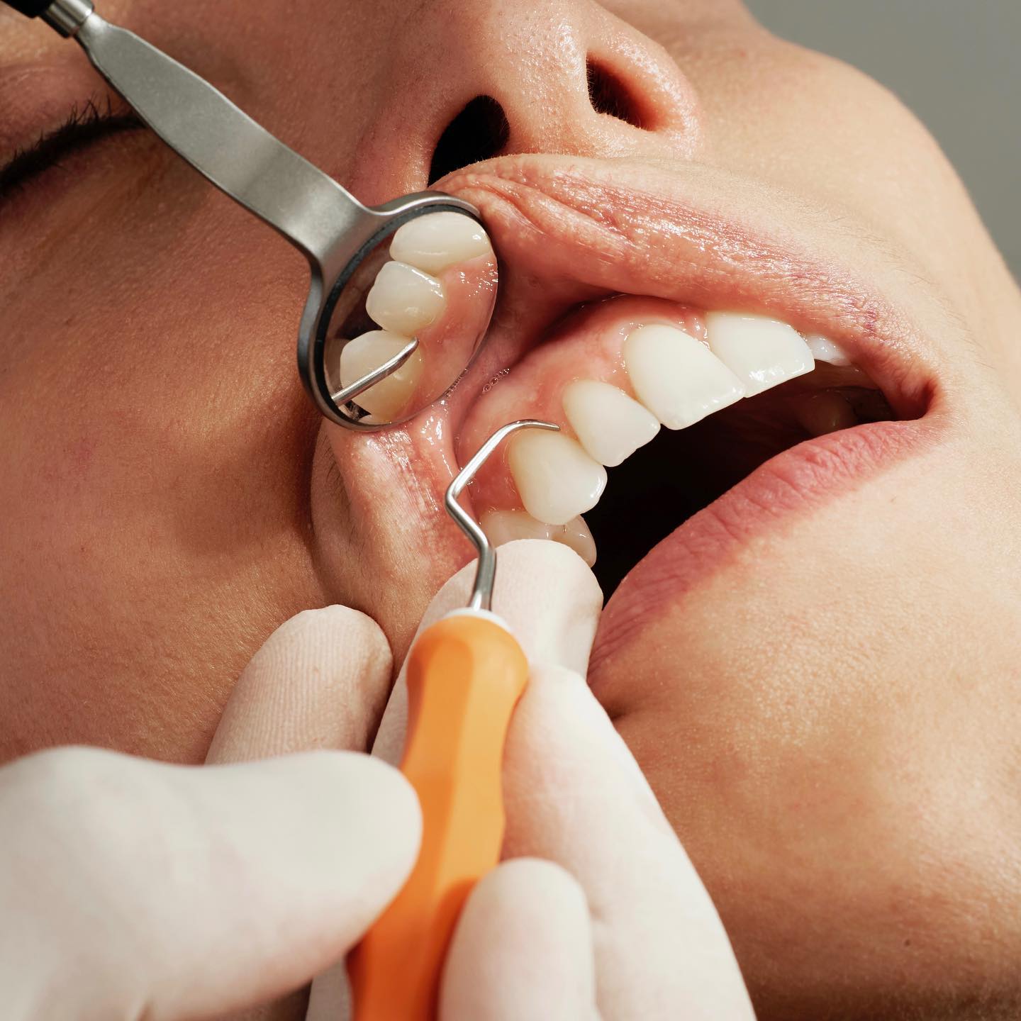 Empfindliche Zähne: 7 SOS-Tipps 😬
 
Kennst Du das? Du genießt ein kühles Eis als plötzlich - autsch! - ein blitzartiger Schmerz durch Deine Zähne fährt. 🦷⚡ 

Schuld daran sind in der Regel freiliegende Zahnhälse, durch die Deine Zähne besonders empfindlich auf Heißes und Kaltes reagieren. 
 
Sensible Zähne sind also ganz schön unangenehm. Deshalb möchten wir Dir 7 schnelle Tipps gegen Schmerzen durch freiliegende Zahnhälse geben:
 
👉 Weniger Druck beim Zähneputzen
👉 Fluoridhaltige Zahnpasta nutzen
👉 Regelmäßige Prophylaxen (Wir führen bei unseren Patienten professionelle kieferorthopädische Zahnreinigungen durch.)
👉 Freiliegende Zahnhälse versiegeln lassen
👉 Besonders heiße und kalte Speisen meiden
👉 Auf säurehaltige Lebensmittel verzichten
👉 Zähneknirschen behandeln (Wir helfen Dir gerne mit einer individuellen, herausnehmbaren Knirschschiene.)
 
Fragen? Dann schreib uns eine Nachricht! 😊
 
Herzliche Grüße ⁣⁣⁣⁣⁣⁣
👨‍⚕️ Dr. Holtkamp & Team⁣⁣⁣⁣⁣
⁣
⁣⁣⁣⁣
#wittmund #ostfriesland #jever #esens #ostfrieslandmomente #kieferorthopädie #kieferorthopäde #zahnarzt #zahnspange #fachzahnarzt #praxis #kfo #dentalart #lächelnnichtvergessen #lächelnmachtglücklich #behandlung #zahnspangenlächeln #schöneslächeln #brackets #zahnspangen #kreativaufinstagram #gemeinsamdurchinsta