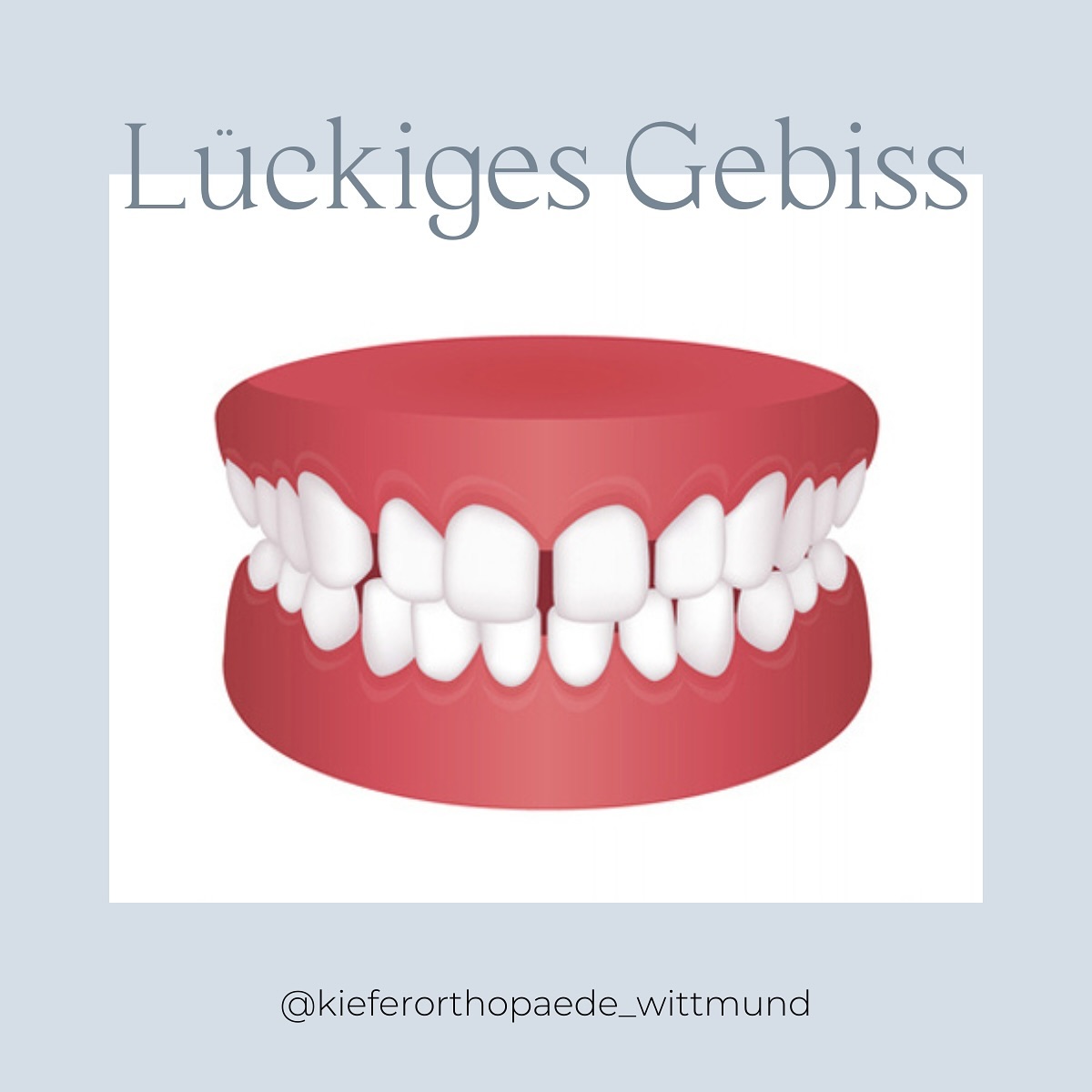 Das lückige Gebiss 🦷
 
Beim lückigen Gebiss handelt es sich um eine Zahnfehlstellung, bei der große Zahnzwischenräume vorhanden sind und die Zähne nicht eng aneinanderliegen. 😬

Dies kann verschiedene Ursachen haben, wie zum Beispiel zu kleine Zähne im Verhältnis zum Kiefer oder das Vorhandensein von Zahnlücken. 
 
Das Problem:

⚡️ Ein lückiges Gebiss kann nicht nur ästhetisch stören, sondern auch funktionelle Probleme verursachen.

⚡️ Zahnzwischenräume können die Reinigung der Zähne erschweren und somit das Risiko von Karies und Zahnfleischerkrankungen erhöhen. 

Die Lösung: 

👉 Durch eine kieferorthopädische Behandlung können die Zähne gezielt bewegt werden, um Lücken zu schließen und ein harmonisches Gebiss zu erreichen.
 
👉 Die Behandlungsmethoden variieren je nach individuellem Fall: Es können feste Zahnspangen, herausnehmbare Apparaturen oder sogar unsichtbare Aligner zum Einsatz kommen. 

👉 Welche Option für Dich am besten geeignet ist, kann in einer ausführlichen Untersuchung festgestellt werden.
 
Du hast Fragen oder möchtest einen Termin vereinbaren? Wir stehen Dir gern zur Verfügung! 😊 Melde Dich telefonisch bei uns unter: 04462 / 20910
 
Herzliche Grüße
👨‍⚕️ Dr. Holtkamp & Team⁣⁣⁣⁣⁣
 

#wittmund #ostfriesland #jever #esens #ostfrieslandmomente #kieferorthopädie